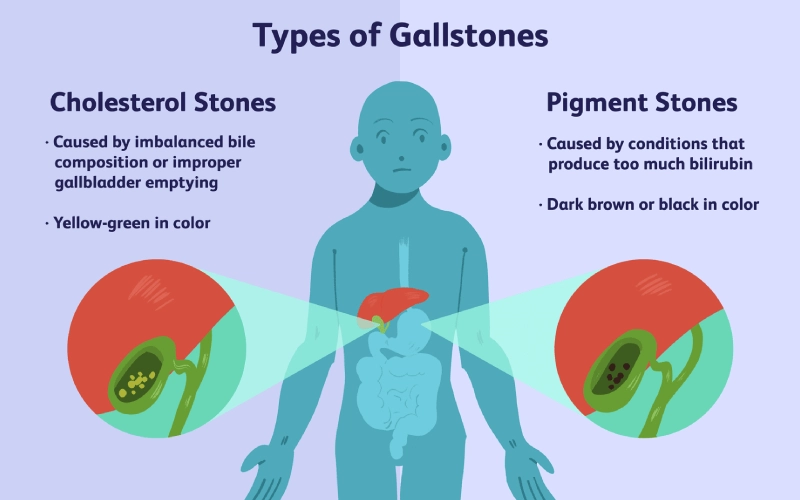 Cholerhiasis meaning and symptoms