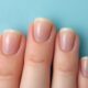 Hypothyroidism and Thyroid Nails