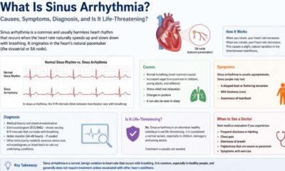 What Is Sinus Arrhythmia