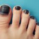 Black Toenail and Diabetes